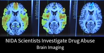 A collage of three MRI scans of the brain each showing a different view of the human brain. The scans are arranged in a triangular formation with the left side showing the left and right side of the image showing the brain in blue and yellow colors. The left side shows the cerebellum while the right side shows a normal brain with a blue and green color scheme. The brain appears to be in a state of disarray with some areas appearing darker and others appearing lighter. The image is accompanied by text that reads "vida Scientists Investigate Drug Abuse Brain Imaging."