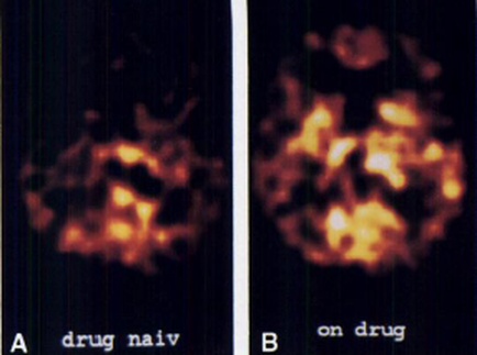 A collage of two photographs side by side. On the left there is a close-up of a drug nail which appears to be a type of cancer cell. The background of both photographs is black and the image is taken from a top-down perspective. On the right there are two photographs of the same drug one in orange and the other in black. The orange photograph shows a cluster of small irregularly shaped cells which appear to be glowing orange and yellow in color. The cells are arranged in a circular pattern with some overlapping each other. The center of the image shows a larger cluster of cells while the outermost cells are smaller and more densely packed together. The image is labeled with the letters "A" and "B" in white text.