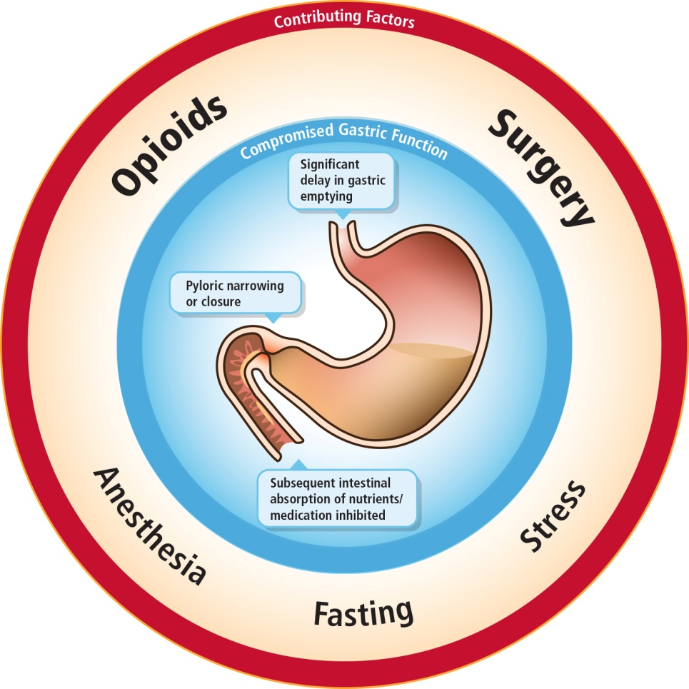 A circular diagram that shows the potential effects of opioids surgery anesthesia fasting and stress on gastric function. "Compromised gastric function" may be observed in "Significant delay in gastric emptying" "Pyloric narrowing or closure" "Subsequent intestinal absorption of nutrients / medication inhibited" etc. <br /><br />The background is blue white and red with graphic elements in brown with text in black and white.