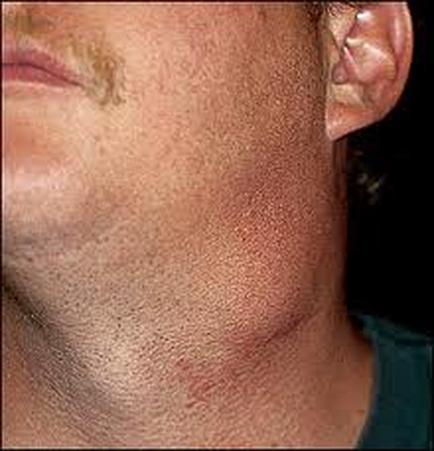 A close-up of a person's neck and upper body. The person appears to be in their late twenties or early thirties. The skin around the neck is rough and uneven with some areas appearing darker and others lighter. There is a small amount of redness or swelling on the skin which may be caused by a scar or a rash. The scar is located on the left side of the neck area and is slightly larger than the rest of the skin. On the right side there is a smaller area of the person's ear which is visible in the top right corner of the image. The background is dark and out of focus.