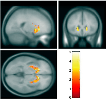A collage of four MRI scans of the brain. The scans are arranged in a grid-like pattern with each scan showing a different view of the human brain. The first scan on the top left shows the left side of the image with the brain in the center. The brain appears to be in a normal state with no visible structures or structures. The image is black and white and the scan is taken from a top-down perspective. In the top right scan there is a close-up view of a person's brain with a yellow dot in the middle of the scan. The yellow dot is likely the location of a tumor or a tumor in the brain which is likely a result of a brain tumor. The red dot is a representation of the tumor and it is likely that the tumor is located in the lower part of the head and neck area. The scan also shows a bar graph in the bottom right corner which shows the percentage of patients who have been diagnosed with cancer.