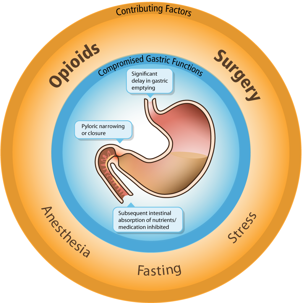 A circular diagram that shows the potential effects of opioids surgery anesthesia fasting and stress on gastric function. "Compromised gastric function" may be observed in "Significant delay in gastric emptying" "Pyloric narrowing or closure" "Subsequent intestinal absorption of nutrients / medication inhibited" etc. <br /><br />The background is orange and blue with graphic elements in brown with text in black and gray.