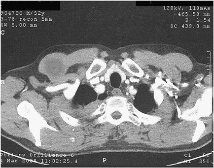 A black and white CT scan of a human skull. The skull appears to be in the center of the image with the surrounding area surrounding it. The image is taken from a top-down view and the skull is clearly visible. The skull is divided into two sections with a large area in the top left corner and a smaller area on the bottom right corner. The top section of the skull has a small amount of blood vessels while the bottom section has a larger area with a few smaller vessels. The blood vessels are arranged in a circular pattern around the skull with some of them overlapping each other. The vessels appear to be connected to the skull by a series of curved lines which may be nerves or arteries. - The image also shows the location of the blood vessels in the skull's head and neck as well as the surrounding structures. There are also several small structures scattered throughout the image. The overall appearance is of a large irregularly shaped structure possibly a brain or a spinal cord.