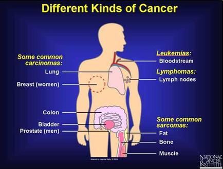 A diagram of the different kinds of cancer. It shows a human body with various organs and structures labeled. The body is shown in a light blue color and is divided into different sections. On the left side of the image there is a label that reads "Some common carcinomas: Lung Breast (women) Colon Bladder Prostate (men) Fat Bone Muscle". On the right side there are labels that read "Leukemia" "Bloodstream" "Lymphoma" "Lymph nodes" and "Some Common Sarcomas". The image also has a title at the top that says "Different Kinds of Cancer". The background is a dark blue color.