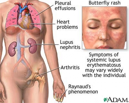 A cross-section of a human body showing the internal organs and structures of the human body. On the left side of the image there is a diagram of the heart and lungs with the heart in the center and the lungs on the right side. The heart is divided into two sections one labeled "Pleural effusions" and the other labeled "Heart problems". On the top right corner there are two images - one of a woman's face with a butterfly rash on her forehead and the text "Symptoms of systemic lupus erythematosus may vary widely with the individual reynard's phenomenon". The woman appears to be in pain or discomfort with her eyes closed and her head tilted back. The image also has a label on the bottom right corner that reads "reynaud’s phenomenon".