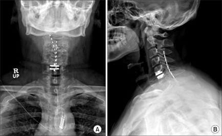 A collage of two X-ray images of a human neck and upper body. The left side of the image shows the neck and neck area while the right side shows the back of the neck. The image is labeled "RUP" and "A" and is labeled as "B". In the image there is a cross-section of the human neck showing the vertebrae and the spinal cord. The spinal cord is visible in both images with the RUP on the left and the B on the right. The X-rays appear to be in good condition with no visible signs of wear or damage. The image also shows a small amount of blood or fluid in the neck which is likely due to the presence of a large amount of fluid. The RUP is located in the center of the spine and it appears to be attached to the neck with a metal rod. The metal rod is likely a medical device possibly a surgical instrument and is likely used to measure the size and shape of the vertebral column. The background of both images is black making the white lines stand out.