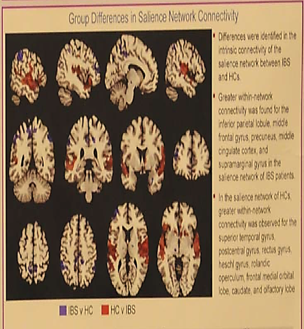 This is a color-coded diagram with annotations showing Group differences in salience network connectivity in the human brain. IBS vs. HC is shown in purple and HC vs. IBS is shown in red.
