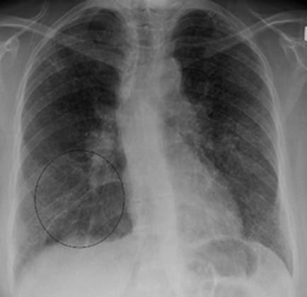 An X-ray of a human chest specifically the chest cavity. The image is black and white and appears to be an radiograph as there is a large circular area in the center of the image. The area is surrounded by a series of thin white lines that appear to be radiographs. The lines are arranged in a radial pattern with the topmost line being the largest and the bottommost being the smallest. There is also a small circular area on the left side of the chest which is likely the location of a small amount of blood or fluid in the air. The overall appearance is that of a person's chest cavity as the lines are not clearly visible.