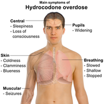 A diagram of the main symptoms of hydrocodone overdose. It shows a young man with a serious expression on his face. The diagram is divided into three sections each representing a different symptom. The first section is labeled "Central Sleepiness - Loss of Consciousness" and shows the symptoms of the overdose. The symptoms include: - Central sleepiness - Loss of consciousness - Skin - Coldness - Clamminess Breathing - Slowed - Shallow - Stopped - Muscular Seizures There are also labels on the left side of the image that describe the symptoms. The first section mentions that the symptoms are: - Pupils - Widening - Breathing Overall the image is meant to illustrate the symptoms and symptoms associated with hydrocodones overdose.