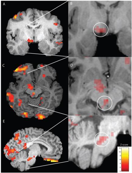 A collage of four MRI scans of the human brain. The scans are arranged in a grid-like pattern with each scan showing a different view of the brain. The top left scan shows the left side of the image with the top right scan showing the brain in black and white. The brain is shown in red and orange with a red dot in the center. The red dot appears to be a representation of the cerebellum while the orange dot is a representation from the brainstorm. In the top center scan there is a white circle with a black outline which is likely the location of the tumor. The white circle is likely a tumor as indicated by the red dot. The image also shows a red arrow pointing to the tumor indicating that the tumor is located in the right side of this scan. - The bottom left scan is a close-up of the left brain showing the different areas of the skull including the cerebrum cerebellums and brainstorm as well as the surrounding area. The bottom right scan is an MRI scan of the right brain which shows the same tumor but with a different color scheme. The colors in the image are red orange and yellow which may indicate the presence of a tumor in the skull.