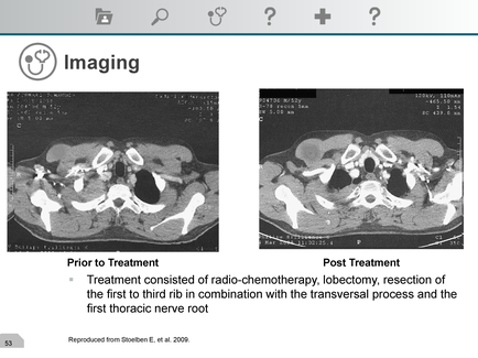 A screenshot of an MRI scan of a patient's head and neck. The scan is divided into two sections one on the left side and the other on the right side. The left side of the image shows the head of the patient with a large tumor in the center. The tumor appears to be in the middle of the head with a small amount of blood vessels surrounding it. The blood vessels are white and appear to be inflamed. The image is labeled "Prior to Treatment" and "Post Treatment". Below the image there is a text that explains that the patient is treated with radio-chemotherapy lobectomy resection of the first to third rib in combination with the transversal process and the first thoracic nerve root. The text also mentions that the treatment was performed from St. Joseph E. et al. 2009. At the top of the screenshot there are several icons including a magnifying glass a question mark and a calculator.