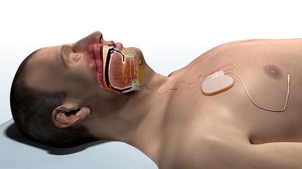 A 3D rendering of a man lying on his back with his eyes closed and his mouth slightly open. He appears to be unconscious or unconscious. The man's body is bare and his head is tilted back slightly to the side. On the right side of the image there is a medical device attached to his chest which is connected to his neck with a wire. The device is orange and yellow in color and has a small white tube attached to it. The tube is likely used to connect the device to the man's chest and neck. The background is plain white.