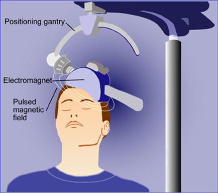 A person's head with their eyes closed and their head tilted back as if they are sleeping. The person is wearing a blue t-shirt and is standing in front of a blue background. On the right side of the image there is a medical device which appears to be a positioning gantry which is a device used to measure the position of the gantry in the head. The gantry is attached to a pole with a curved arm that extends from the top to the bottom. The arm is connected to an electromagnet which can be used to pulse the magnetic field of the person's brain. The magnetic field is also connected to the garter which helps to keep the brain in place while they sleep.