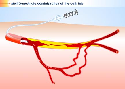 A medical illustration of a multiGeneAngio administration at the cath lab. It shows a syringe with a needle inserted into a blood vessel which is red and yellow in color. The syringe is connected to the vessel with a white cord. The vessel appears to be in the process of being injected as there is a red line running through it. The background is a light pink color and there is text on the top and bottom of the image that reads "MultiGeneAngios administration at cath lab".