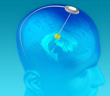 A 3D rendering of a human head with a blue background. The head is facing towards the right side of the image. On top of the head there is a white circle with a yellow dot in the center which appears to be a brain scan. The yellow dot is likely a representation of the brain scan which is a medical device used to scan the brain for abnormalities or abnormalities. The white circle is connected to the yellow dot by a thin white line which may be a sensor or a device that detects the presence of a person's brain. The image also has a blue gradient background giving it a futuristic and technological feel.