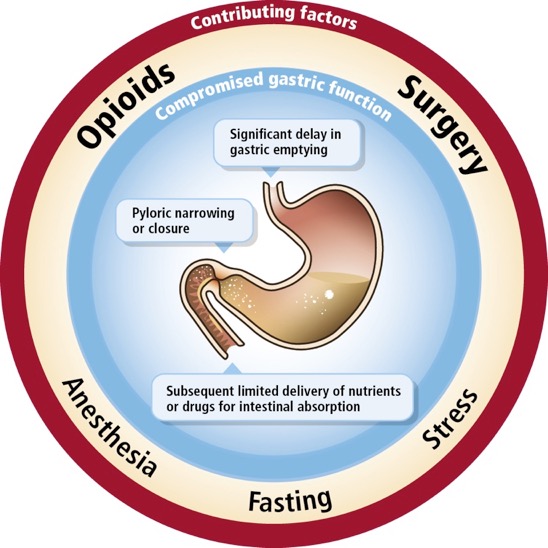 A circular diagram that shows the potential effects of opioids surgery anesthesia fasting and stress on gastric function. "Compromised gastric function" may be observed in "Significant delay in gastric emptying" "Pyloric narrowing or closure" "Subsequent intestinal absorption of nutrients / medication inhibited" etc. <br /><br />The background is blue white and red with graphic elements in brown with text in black and white.
