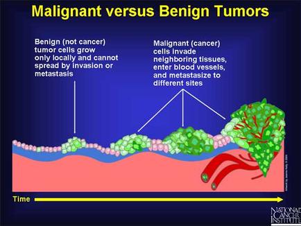 A diagram that shows the difference between benign tumors and benign tumors. The diagram is divided into two sections. On the left side of the image there is a line graph that shows that benign (not cancer) tumor cells grow only locally and cannot spread by invasion or metastasis. On the right side there are two types of tumors - benign (cancer) cells invade neighboring tissues enter blood vessels and metastasize to different sites. The tumor cells are shown in green and pink colors while the tumor cells in red are shown as red and green. The background is blue and the diagram is accompanied by text that explains the differences between the two types.