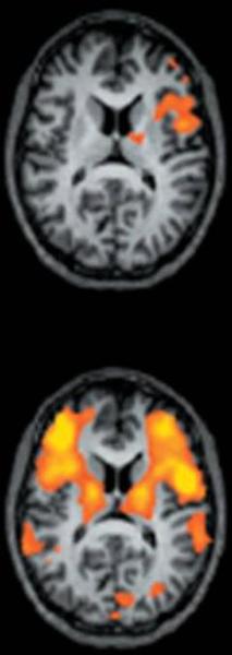 A CT scan of the brain which is a type of MRI scan that shows the brain in two different views. The scan is circular in shape and appears to be a cross-sectional view of the human brain. In the top view the brain is shown in black and white with the top half of the image being the largest and the bottom half being the smallest. The brain is divided into two sections with a central area in the center and a smaller area on the left side. The central area is filled with orange and yellow areas which appear to be the areas where the brainstorm is located. The orange areas are likely the areas that are affected by the brain activity while the yellow areas are areas where it is affected by a brain activity. - The image is taken from a top-down perspective and the background is black making the orange areas stand out. The image appears to have been taken at night as there are no other objects in the image.