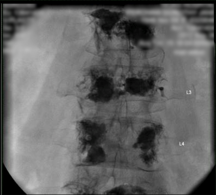 A black and white X-ray of a human body specifically the head and neck. The image appears to be an MRI scan as there are multiple lines and structures visible in the image. The lines are arranged in a grid-like pattern with the topmost line being the largest and the bottommost being the smallest. The structures appear to be irregularly shaped with some areas appearing larger and more prominent. There are also several smaller structures scattered throughout the image including a large area in the center which is likely the head neck or spine. These structures are likely caused by a large amount of blood or fluid in the body as indicated by the "L3" and "L4" labels on the right side of the image respectively. The background is blurred so the focus is on the structures.
