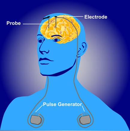 A diagram of a human head and neck with the brain in the center. The brain is colored orange and yellow representing the different parts of the brain. On the left side of the image there is a probe an electrode and a pulse generator. The probe is located on the top left corner of the head while the electrode is on the bottom right corner. The pulse generator is located in the middle of the neck. The background is blue and the image is in a 3D style.