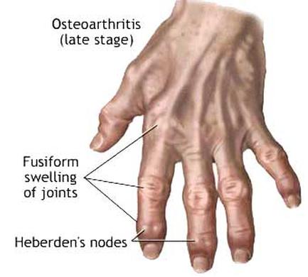 A cross-section of a hand specifically the wrist and fingers. The hand appears to be in pain or discomfort as indicated by the text on the image. The text reads "Osteoarthritis (late stage) Fusiform swelling of joints" and "Heberden's nodes". The image is labeled with the names of the bones and their locations. The bones are arranged in a way that they form a ring around the wrist with the fingers slightly curled at the tips. The fingers appear to be swollen and inflamed with some areas appearing to be discolored and irritated. The image also shows the location of the heerlen nodes on the wrist.