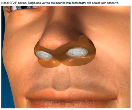 A close-up of a person's nose with two nasal pap devices inserted into each nostril and sealed with adhesive. The devices are brown in color and appear to be made of a flexible material. The person's mouth is slightly open and their lips are slightly parted. The image is a 3D rendering and there is text on the top right corner that reads "Nasal pap device. Single use valves are inserted into the nostril & sealed with adhesives."