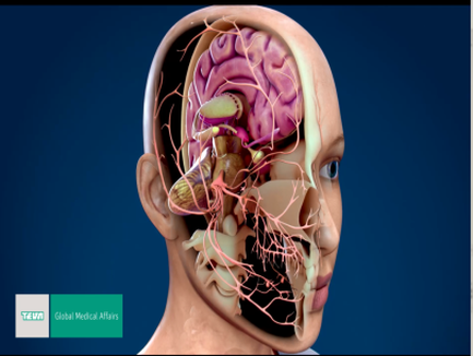 A 3D rendering of a human head and neck showing the internal structure of the head. The head is shown from the side with the brain and neck visible. The brain is in the center of the image with a large purple area in the middle which appears to be the brainstorm. The neck is on the right side and the brain is on top of the neck. The brain is surrounded by a network of blood vessels which are visible in the image. The blood vessels are arranged in a way that they form a complex network around the head connecting the brain to the neck and neck. There are also several arteries and veins running through the brain which help to regulate the flow of blood and other medical fluid. The image is labeled with the text "Global Medical Affairs" at the bottom indicating that it is a medical illustration.