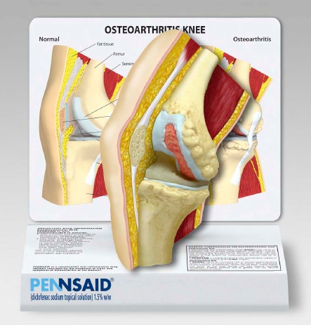 A photograph of a medical model showing the osteoarthritis knee. It is a cross-section of the knee showing the bones and ligaments. The model is sitting on a stand which appears to be made of white cardboard. The stand has medical illustrations of a normal and osteoarthritis knees behind the model. The base of the stand has the Pennsaid logo.
