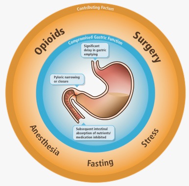 A circular diagram that shows the potential effects of opioids surgery anesthesia fasting and stress on gastric function. "Compromised gastric function" may be observed in "Significant delay in gastric emptying" "Pyloric narrowing or closure" "Subsequent intestinal absorption of nutrients / medication inhibited" etc. <br /><br />The background is white with graphic elements in orange blue and brown with text in black and white.