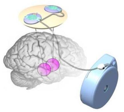 A 3D model of a human brain with a blue circular device attached to it. The device appears to be a sensor or a device that is used to measure the movement of the brain. The brain is shown in a light grey color and is connected to the device by a thin black wire. On top of the device there are three circular structures which are likely sensors or sensors that are used to detect and monitor the brain's movements. The structures are arranged in a circular pattern with the topmost structure being the largest and the bottommost being the smallest. There are also three pink and purple spheres connected to each other which could represent the different components of the system. The spheres are connected by a series of wires which may be used to connect them to other devices. The wires are likely connected to a computer or other electronic device such as a mouse or a computer mouse. The background of the image is white which makes the blue device stand out.