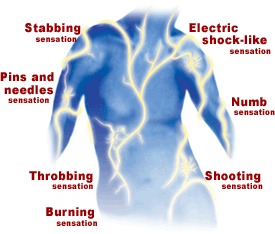 A diagram of the back of a person's body with a lightning bolt-like pattern on it. The image is labeled with a number of painful or uncomfortable sensations including: electric shock-like stabbing pins and needles throbbing burning shooting and numb.
