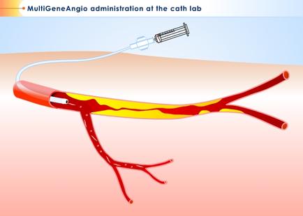 A medical illustration of a blood vessel with a syringe inserted into it. The syringe is connected to the vessel with two red blood vessels one on the left side and the other on the right side. The blood vessels are red and yellow in color and the syringe has a needle inserted into the vessel. The background is a light pink color. The image is labeled "MultiGeneAngio administration at the cath lab".
