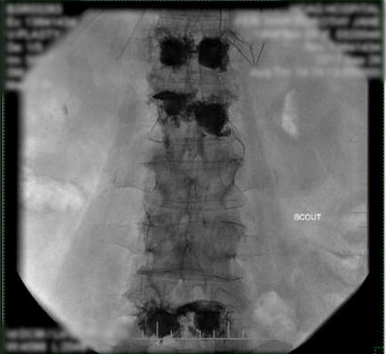 An X-ray of a human spine specifically the cervical vertebrae. The image is black and white and appears to be an MRI scan as indicated by the text "SCOUT" on the right side of the image. The spine is shown in a circular shape with the topmost part of the spine facing towards the left side and the bottommost part towards the right. The vertebrae are arranged in a grid-like pattern with some areas appearing darker and others appearing lighter. There are also several small circular structures scattered throughout the spine which appear to be bones or structures. The structures are labeled with numbers and letters likely indicating the location of the vertebral column. The background of the X-rays is white and the image is framed by a thin black border.