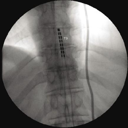 A black and white X-ray of a human neck and neck area. The image is circular in shape and appears to be taken from a top-down perspective. The focal point of the image is the neck which is visible in the center. The neck is divided into two sections with the left side of the neck being the largest and the right side being the smallest. The neck is shown in a straight line with a small amount of blood vessels visible on the left and right sides. The vessels appear to be connected to the neck by a series of thin black lines. The lines are arranged in a grid-like pattern with some areas appearing darker and others appearing lighter. There are also several small white dots scattered throughout the image which could be blood vessels or blood vessels. The overall appearance of the human neck appears to have a serious or serious expression on its face.