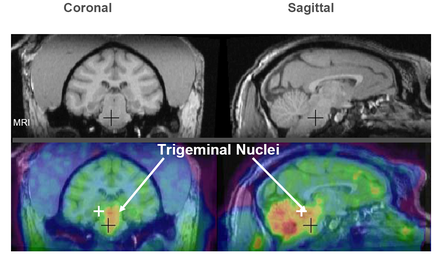 A collage of three MRI scans of the brain labeled as "Coronal" "Sagittal" and "Trigeminal Nuclei". The scans are arranged in a grid-like pattern with each scan showing a different view of the human brain. The first scan on the top left shows the normal brain with the left side of the image showing the cerebellum and the right side showing the trigeminal nerve. The brain is shown in black and white while the scan on top right shows the sagittal nerve which is a type of nerve that connects the brain to the spinal cord. The image also shows a cross-sectional view of a tumor in the brain. The tumor appears to be in the center of the head with a red arrow pointing to the left and a green arrow pointing towards the right. The red arrow is likely indicating the location of the tumor which may be a tumor or a tumor that may have been affected by the tumor.