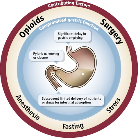 A circular diagram that shows the potential effects of opioids surgery anesthesia fasting and stress on gastric function. "Compromised gastric function" may be observed in "Significant delay in gastric emptying" "Pyloric narrowing or closure" "Subsequent intestinal absorption of nutrients / medication inhibited" etc. <br /><br />There are graphic elements in red white blue and brown with text in black and white.