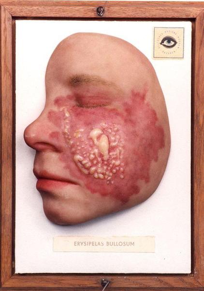 A photograph of a human head and neck framed in a wooden frame. The head appears to be bald and has a large amount of red inflamed skin on its face. The skin is covered in small bumps and bumps and there is a small amount of white substance on the right side of the face. On the left side there is an eye-like structure which could be a symbol of the eye. The text on the frame reads "Erysipelas Bullosum" which is a type of skin cancer. The background of the image is white and the frame is made of wood.