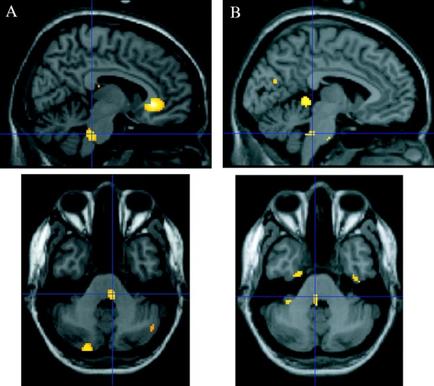 A collage of four MRI scans of the brain each showing a different view of the human brain. The first scan on the top left shows the left side of the image with the brain in the center. The brain is shown in black and white with a yellow square in the middle. The yellow square is likely the location of a tumor or a tumor in the brain. The image is labeled with the letters "A" "B" "C" "D" "E" "F" "G" "H" "J" "K" "L" "M" and "E". In the top right scan the brain appears to be in good condition with no visible signs of damage or damage. The top left and bottom right scans show the same brain but with a different color scheme. There are also several yellow squares scattered throughout the image. These squares are likely representing different areas of the tumor such as the cerebellum cerebrospinal cord and brainstorm. These areas are likely to be affected by the tumor or other abnormalities in the body. The images are arranged in a grid-like pattern with each square representing a different area. The background of each scan is black making the yellow squares stand out.