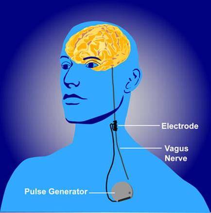 An illustration of a human head with a pulse generator attached to it. The pulse generator is a device used to generate electricity from the brain. The brain is shown in yellow color and is located in the center of the head. The electrode is connected to the vagus nerve which is located on the right side of the image. The diagram also shows the location of the pulse generator in the brain and how it works. The background is blue and the image is in a 3D style.
