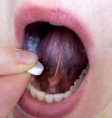 A close-up of a person's mouth with their tongue open. The person is holding a small white pill in their right hand and is about to take a bite out of the gum. The gum appears to be swollen and inflamed with a dark purple color. The teeth are white and appear to be healthy and well-groomed. The background is blurred so the focus is on the person's teeth.