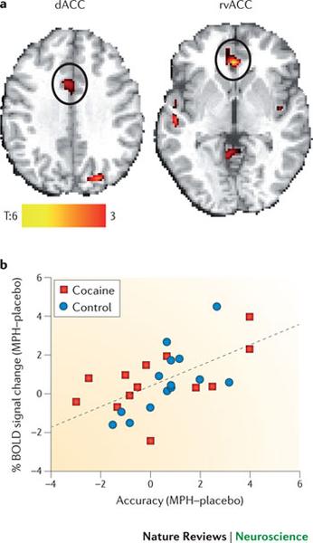 This is two data visualizations : a heat map of the brain (showing both the dorsal anterior cingulate cortex (dACC) and the rostral-ventral anterior cingulate cortex (rvACC)) and a scatter plot (comparing the percentage of BOLD ((blood-oxygen-level-dependent) signal change for cocaine vs. control). The heat map shows both location and intensity on a scale of T:6 (yellow) to 3 (red). The scatter plot has Accuracy (MPH-placebo) on the x-axis and % BOLD signal change (MPH-placebo) on the y-axis with control represented by blue dots and cocaine represented by red boxes.