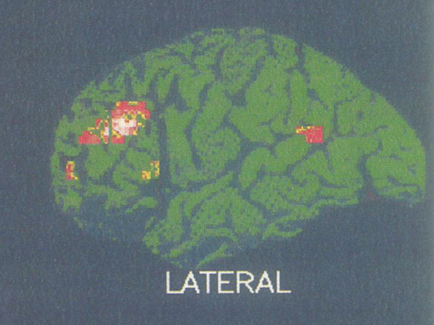 A digital illustration of a human brain with the word "LATERAL" written below it. The brain is green in color and appears to be made up of small squares and rectangles. On the left side of the brain there is a red square with a white outline which could be a representation of a person's brain. The squares are arranged in a way that they form a grid-like pattern with some overlapping each other. The background is black making the green color of the image stand out.