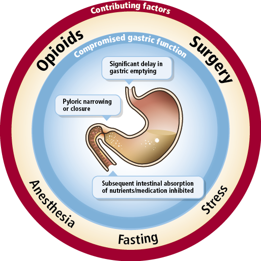 A circular diagram that shows the potential effects of opioids surgery anesthesia fasting and stress on gastric function. "Compromised gastric function" may be observed in "Significant delay in gastric emptying" "Pyloric narrowing or closure" "Subsequent intestinal absorption of nutrients / medication inhibited" etc. <br /><br />The background is blue white and red with graphic elements in brown with text in black and white.