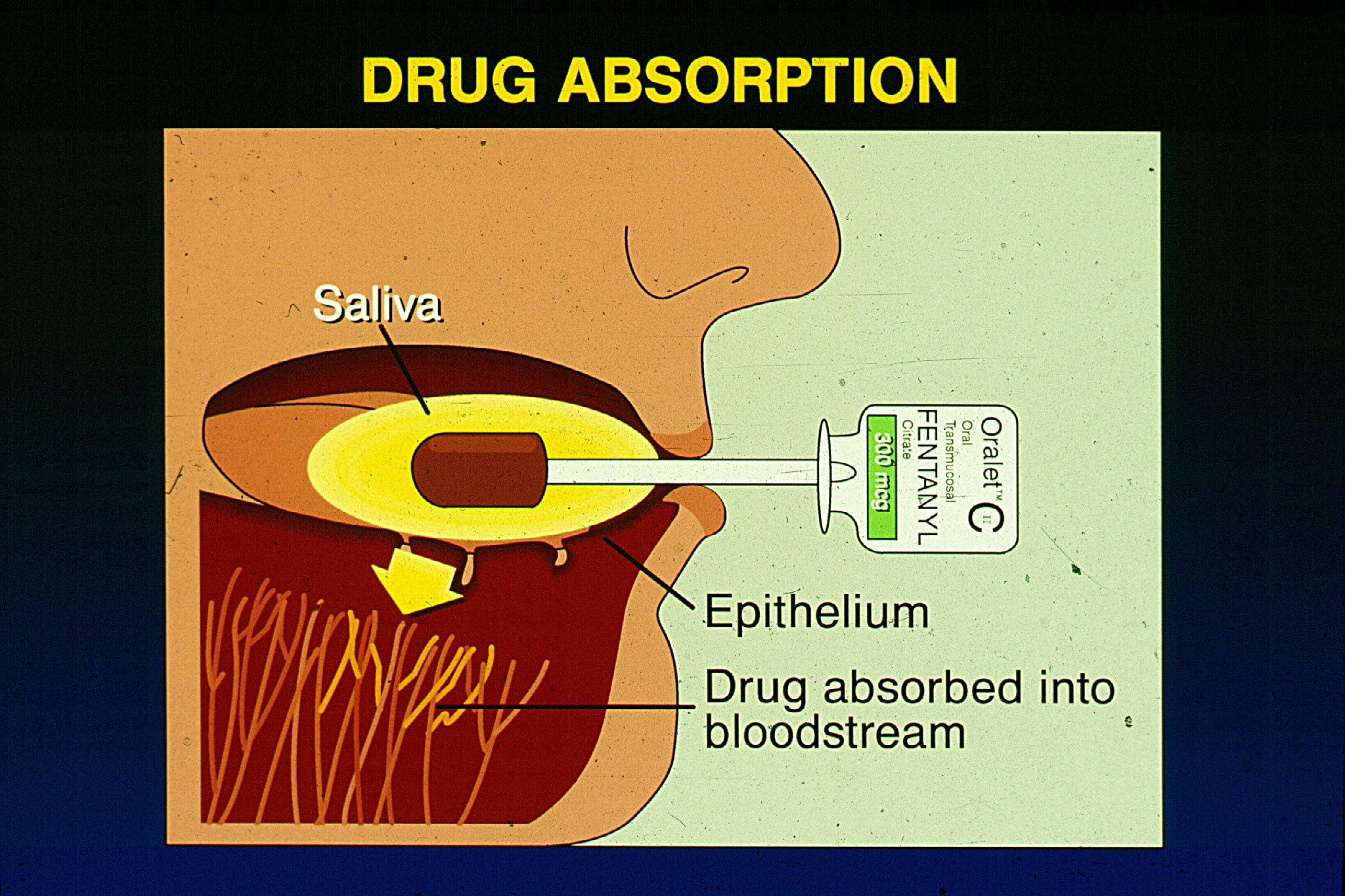 An illustration titled "Drug absorption". It shows a person's mouth with a lozenge on a handle in it. The lozenge is labeled "Oralet Oral Transmucosal Fentanyl Citrate 300 mcg." A yellow circle is around the lozenge in the mouth and it is labeled "saliva". The area under the tongue is labeled "epithelium". A yellow arrow points from the area labeled "saliva" through the area labeled "epithelium" and down to the bottom of the mouth. The bottom section is labeled "Drug absorbed into bloodstream".