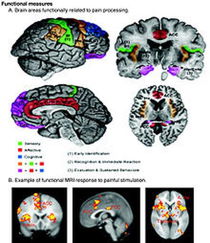 A collage of four different views of the brain each showing a different type of functional measures related to pain processing. The top left view shows the brain with different areas of the human brain including the cerebellum the cerebrospinal cord and the brainstorm. The top right view shows a normal brain with a red and green area in the center which is likely the location of the pain processing area. The brainstorm is colored in red indicating that the pain is caused by pain. In the bottom left view there is a normal MRI scan of the head and neck which shows the location where the pain occurs. The image also shows a comparison of the different areas with the red area representing pain and the green area representing inflammation. The red area represents pain while the orange area represents inflammation which may be caused by the pain in the brain. The text below the image explains that the image is an example of a functional MRI response to painful stimulation which can be seen in the top right corner of the image.