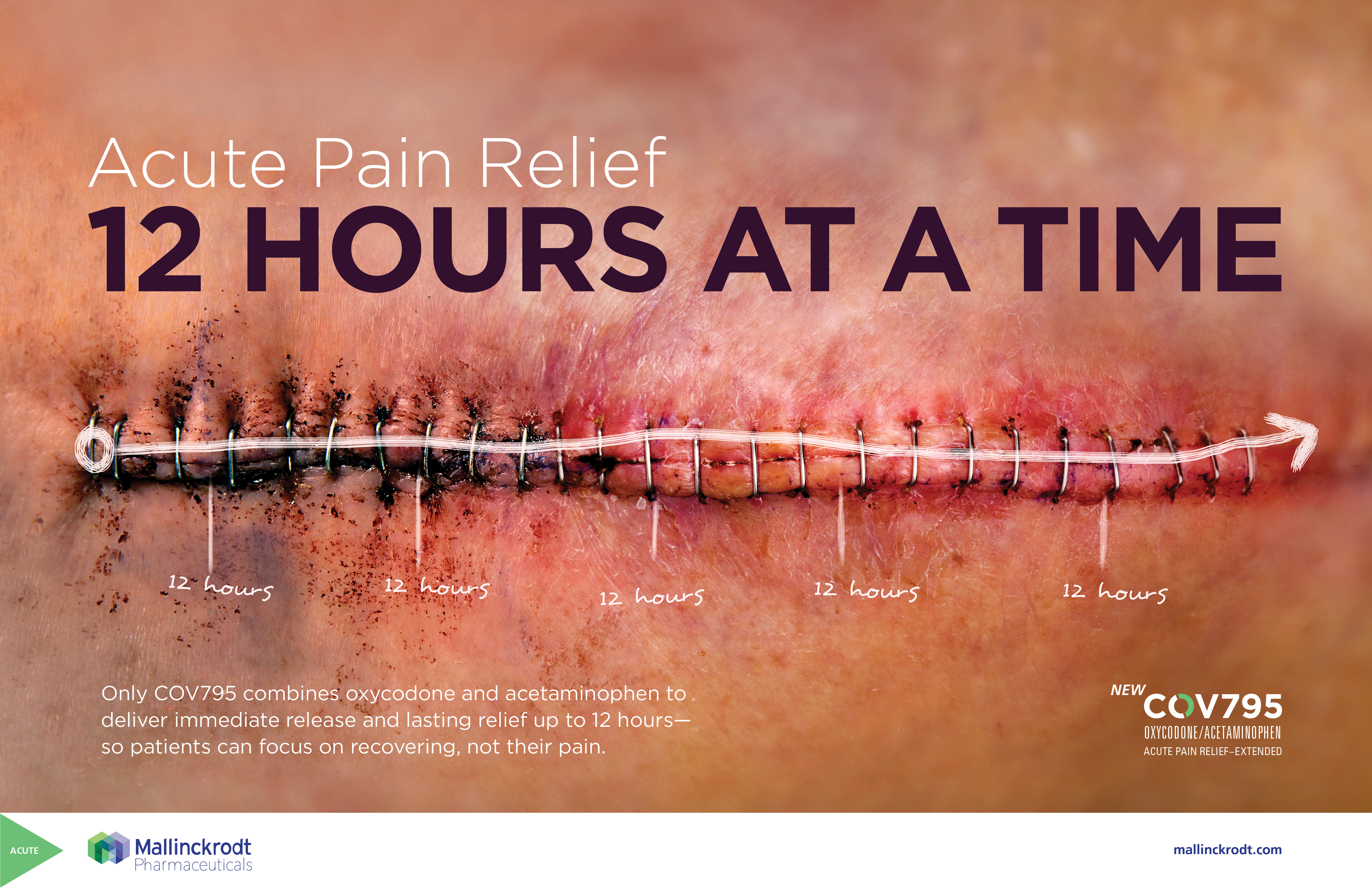 An advertisement for COV795 (oxycodone/acetaminophen) with the taglines "Acute pain relief : 12 hours at a-time" and "Acute pain relief - extended". A photograph of a wound being held shut by 25 staples is in the background with a run chart superimposed over top of it (symbolizing the steady pain relief provided by COV795 presumably). The text is in white and purple. The logo of COV795 is in the bottom right corner and the logo of Mallinckrodt is in the bottom left corner.