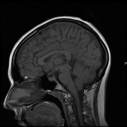 A black and white MRI scan of the head and neck. It appears to be a cross-sectional view of the brain with the left side of the image showing the cerebellum and the right side showing the brainstorm. The brain is shown in a straight line with no visible structures or structures in the image. The image is taken from a top-down perspective and the background is completely black. The brain appears to have a large circular area in the center which is likely the location of the cerebrospinal cord which extends from the brain to the spinal cord. The spinal cord is visible in the bottom right corner of the scan and there is a small amount of blood vessels visible on the left and right sides of the body. The blood vessels appear to be blood vessels which are responsible for the flow of blood and fluid in the brain. The overall appearance of the human brain is clearly visible with a sense of depth and dimensionality.