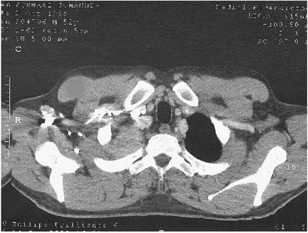 A black and white CT scan of a human skull. The skull appears to be in the middle of a cross-sectional view as there are several bones visible in the image. The bones are arranged in a circular pattern with the largest bone in the center and two smaller bones on either side. The largest bone on the left side of the image is the skull while the smaller bone is on the right side. The image also shows a small amount of blood vessels which are visible on the top left and bottom right sides of the skull. There are also several small structures including a large hole in the top right corner which could be a tumor or a tumor. The image is labeled with the names of the bones such as "R" "C" "D" "E" "F" "G" "H" "J" "K" and "L" indicating that it is an MRI scan. The scan is likely used to diagnose and treat a patient's heart attack or other medical condition.