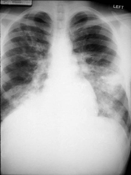 An X-ray of a person's chest specifically the left side of the chest. The image is black and white and appears to be an anteroposterior view of the person's lungs. The person is standing with their head slightly tilted to the left and their chest is visible in the center of the image. The lungs are arranged in a radial pattern with the left and right ventricles on the top and bottom of their chest and the left ventricle on the right side. There is a white cloud-like substance in the middle of the X-rays which could be a fluid or fluid flow. The background is plain white and there is a label on the bottom right corner that reads "LEFT".